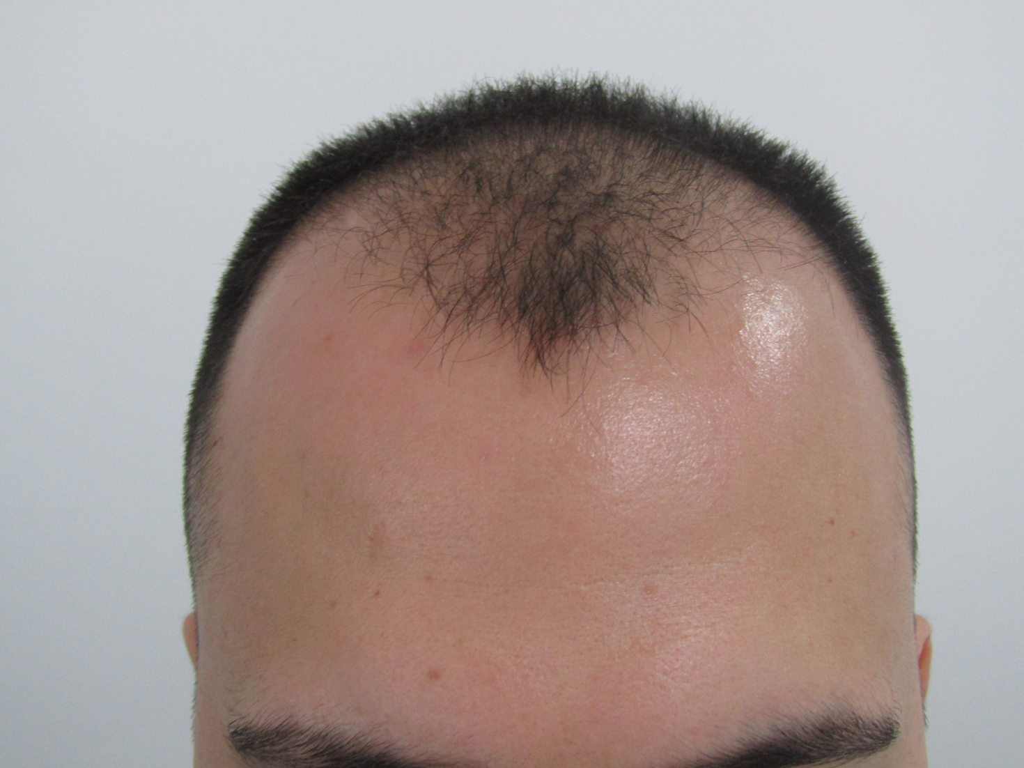 antes