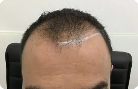 Antes del injerto: caso de entradas y línea frontal publicado por Kaloni.