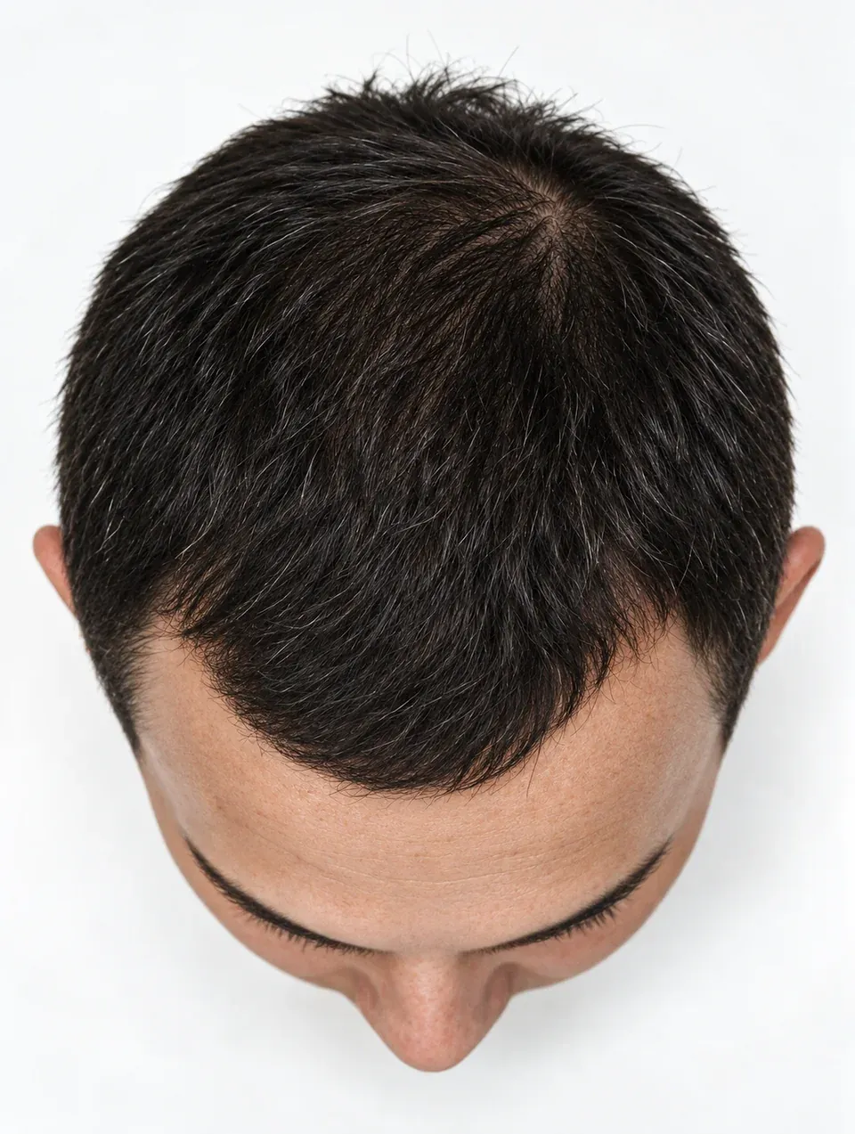 Vista superior de una cabeza masculina con cabello abundante en la zona frontal y superior.