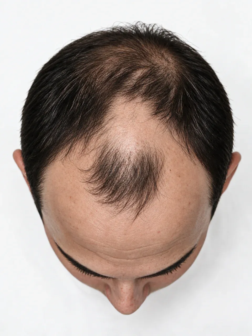 Vista superior de una cabeza masculina con un área frontal despejada y un mechón en el centro.
