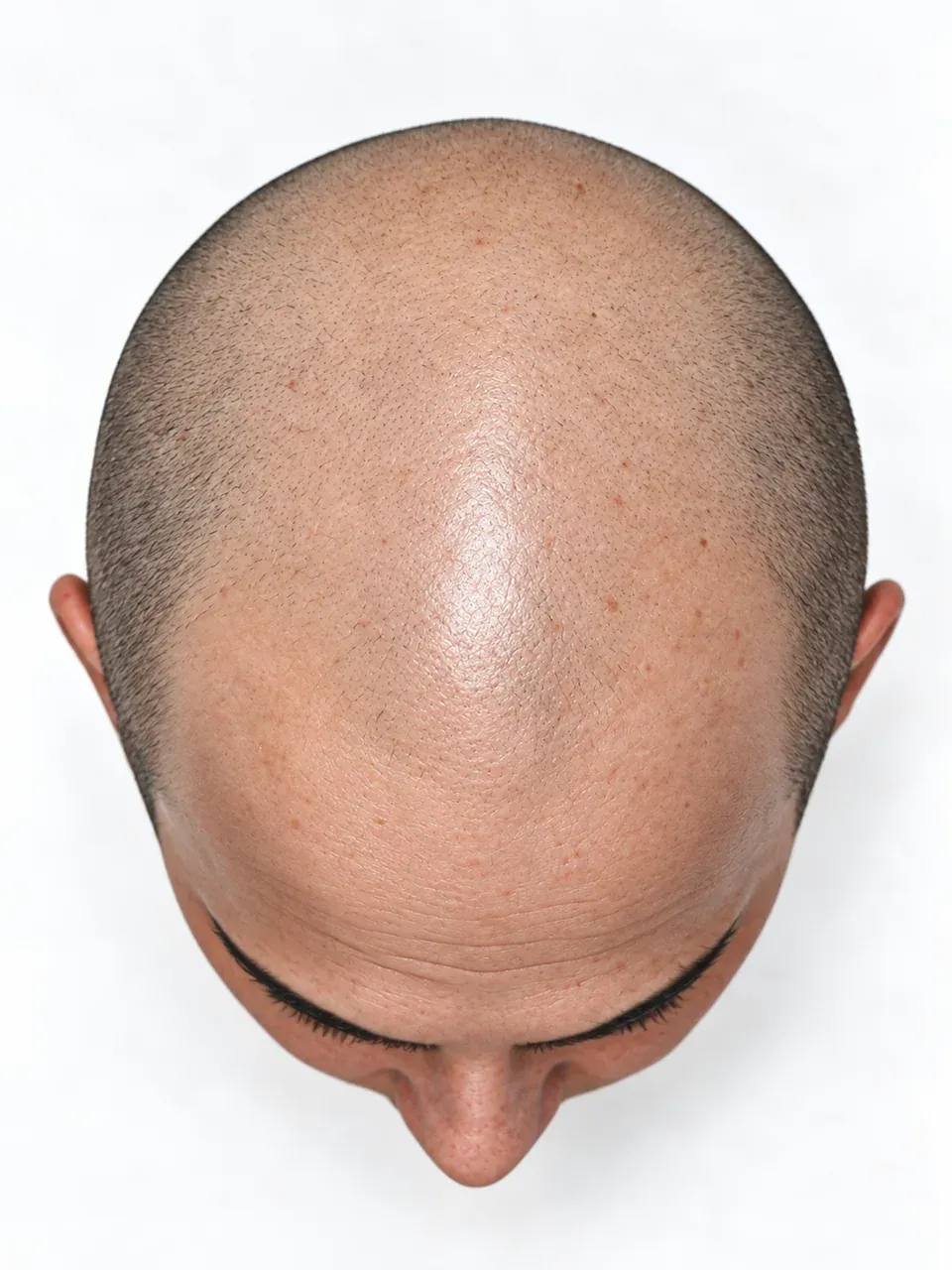 Vista superior de una cabeza masculina con cabello muy corto y disperso sobre la superficie superior.